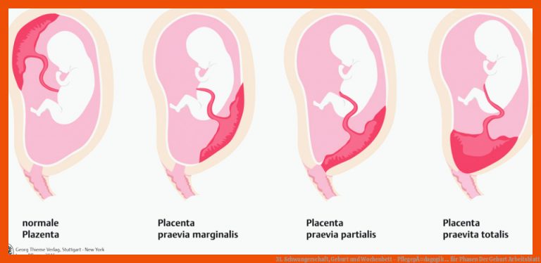 31. Schwangerschaft, Geburt Und Wochenbett - PflegepÃ¤dagogik ... Fuer Phasen Der Geburt Arbeitsblatt