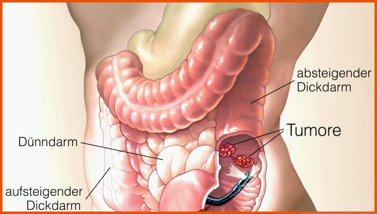 Darmkrebsvorsorge: Das mÃ¼ssen Patienten wissen für arbeitsblätter verdauungssystem anatomie