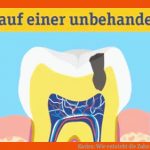 Karies: Wie Entsteht Die Zahnerkrankung? Stiftung Gesundheitswissen Fuer Entstehung Karies Arbeitsblatt