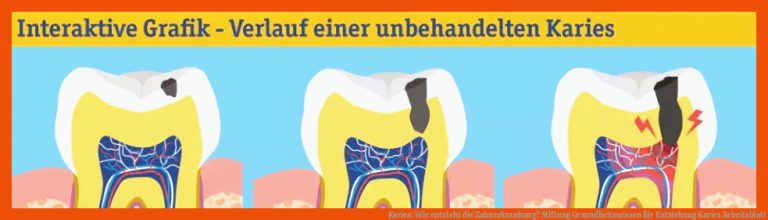 Karies: Wie Entsteht Die Zahnerkrankung? Stiftung Gesundheitswissen Fuer Entstehung Karies Arbeitsblatt